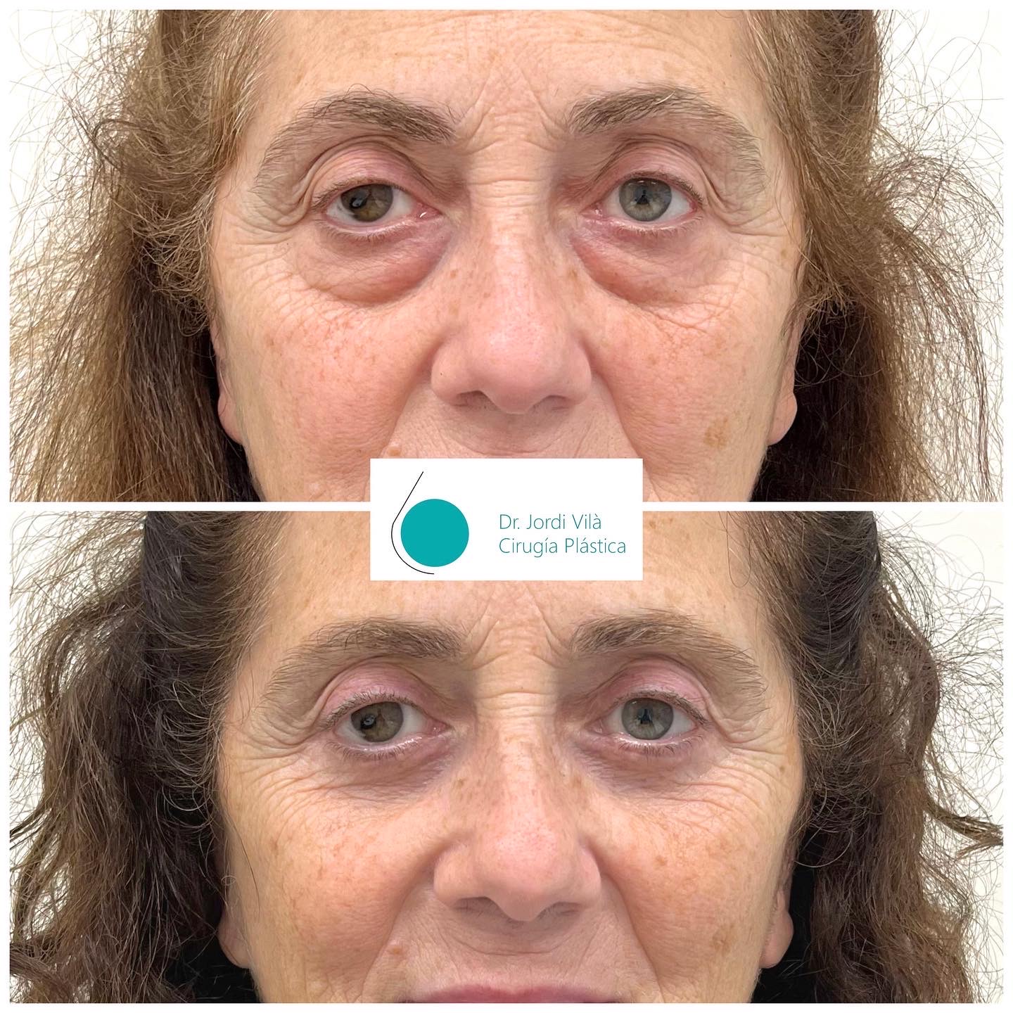 Blefaroplastia