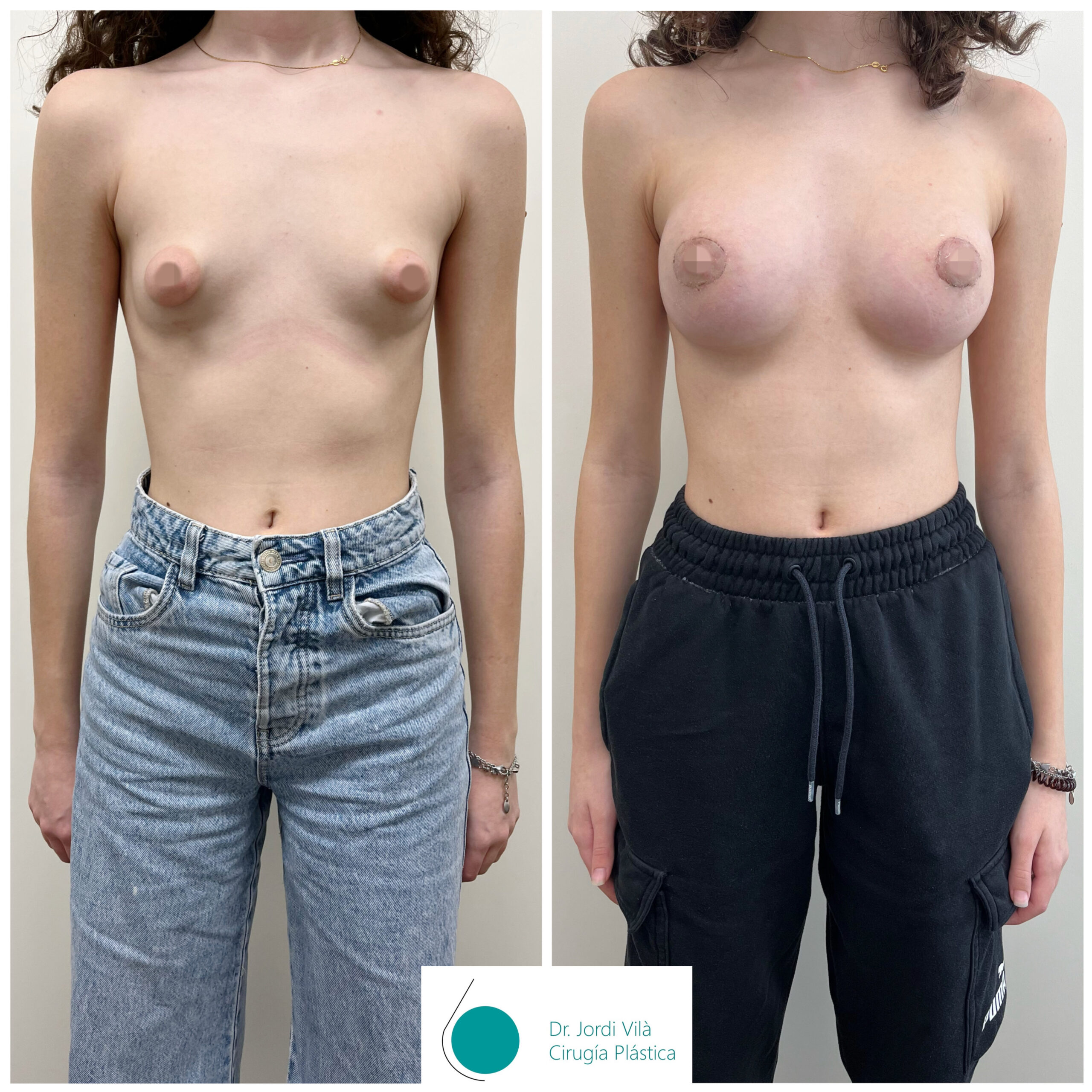 Mastopexia periareolar con prótesis
