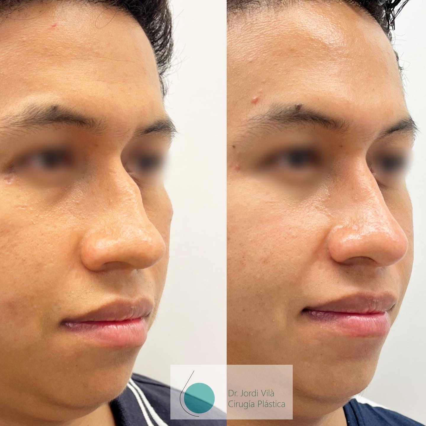 Rinoplastia