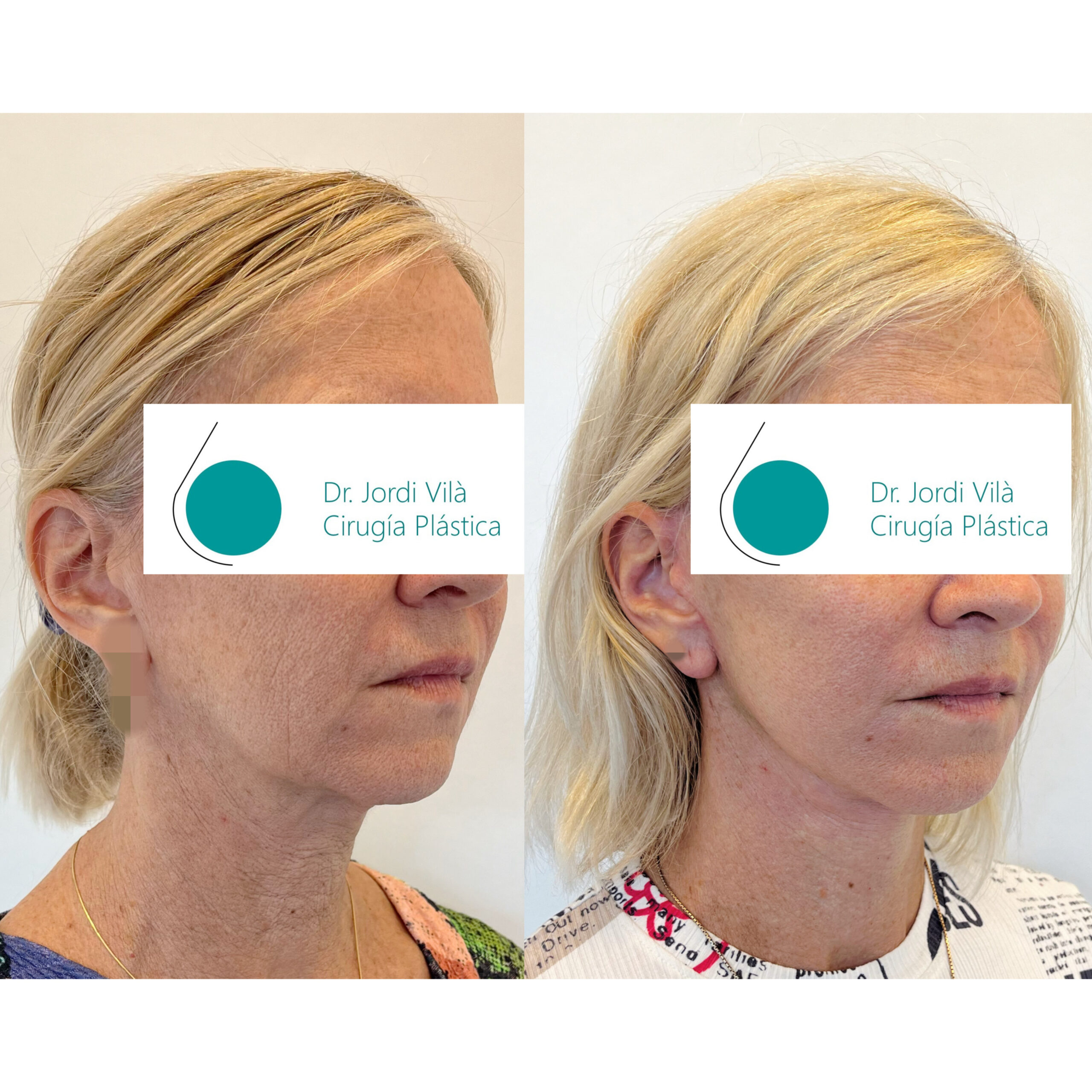 Lifting cervicofacial