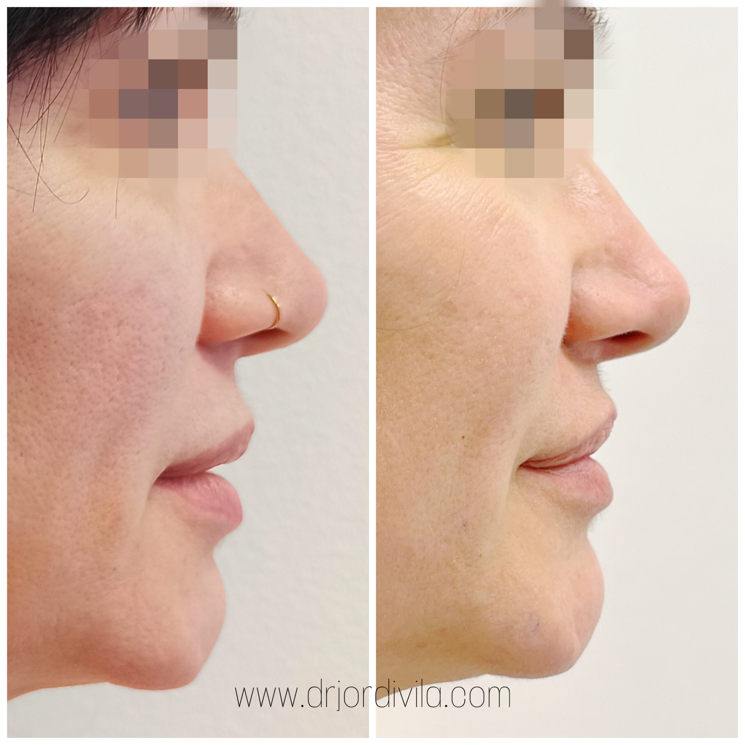 Lip Lift
