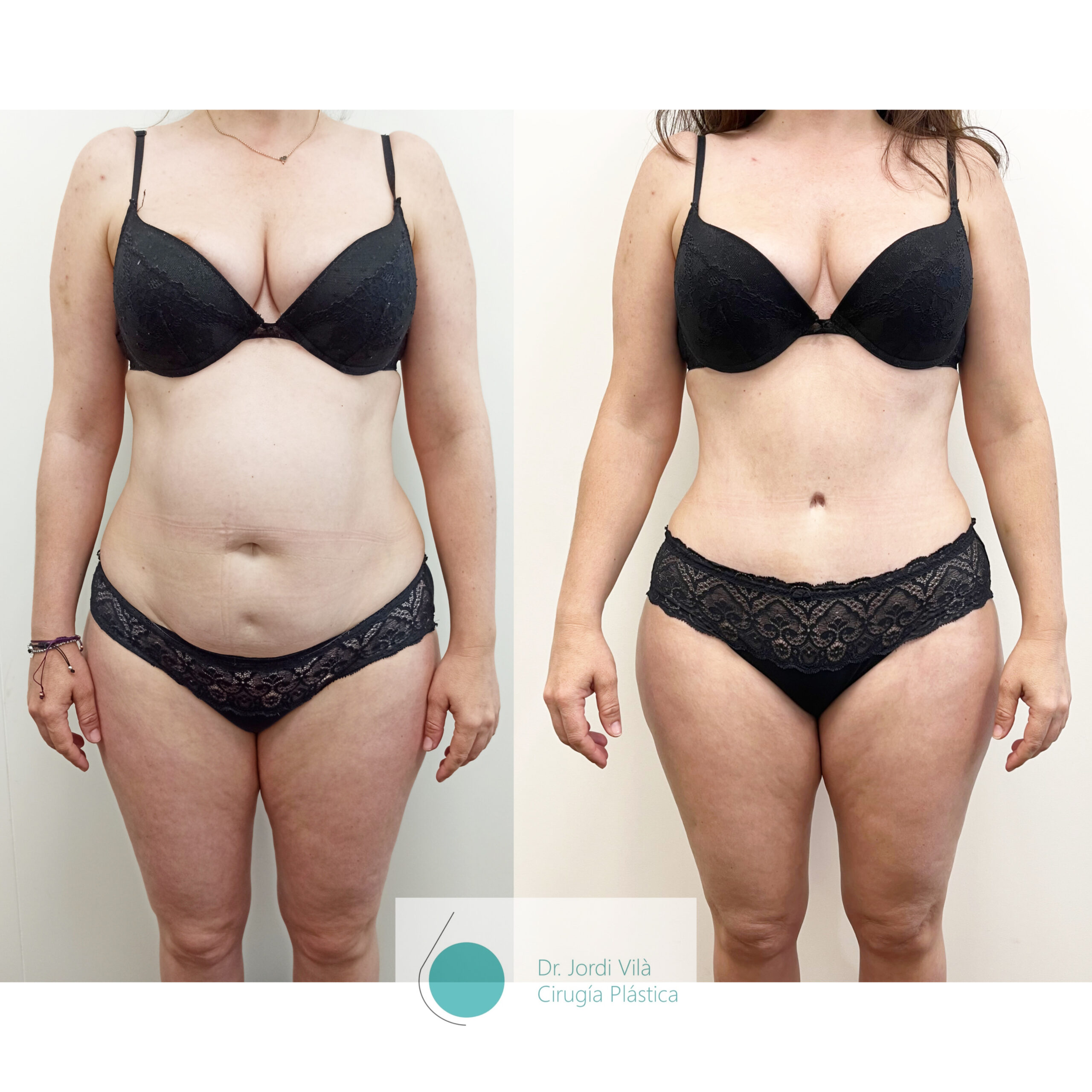 Abdominoplastia