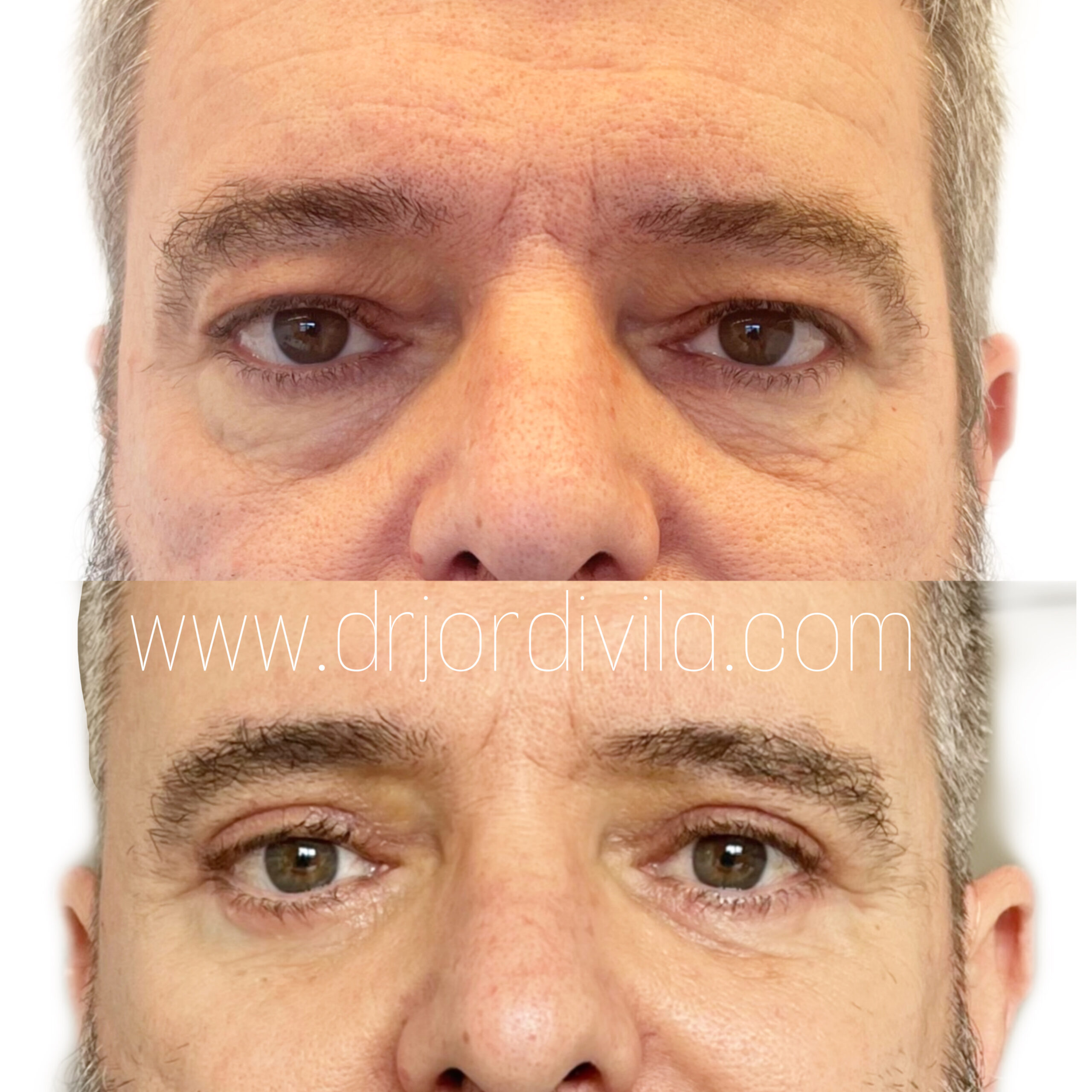 Blefaroplastia