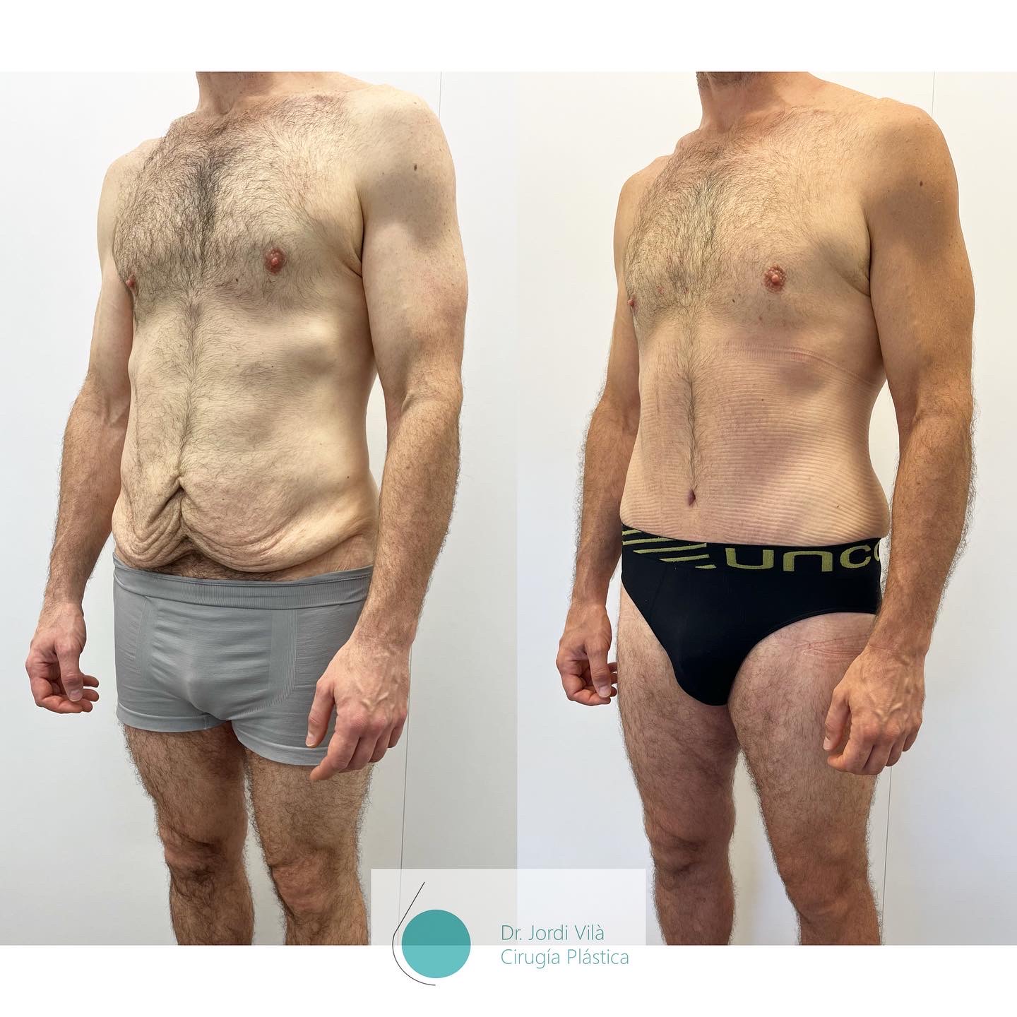 Abdominoplastia