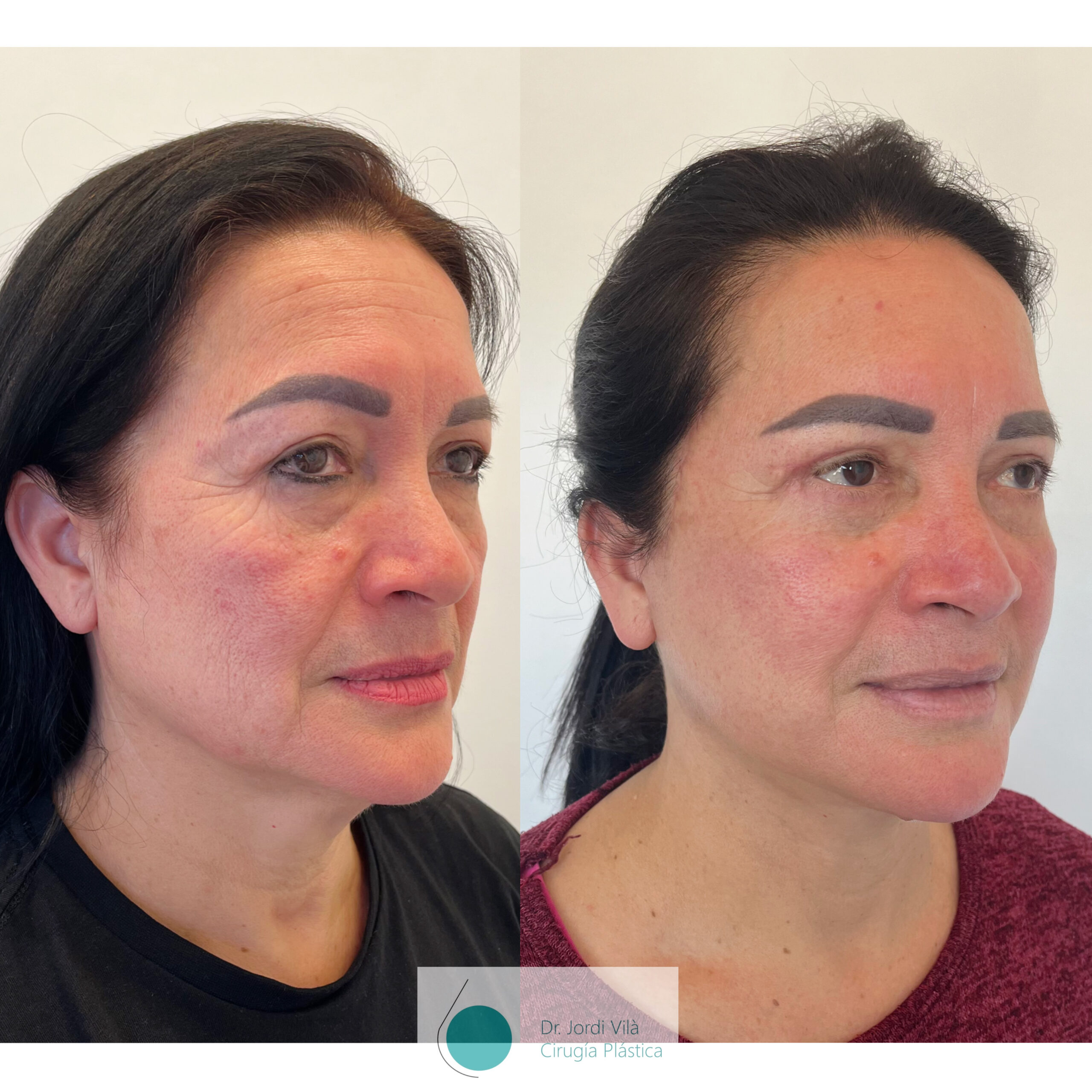 Lifting cervicofacial